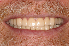 Full Mouth Reconstruction Dentistry After Photo